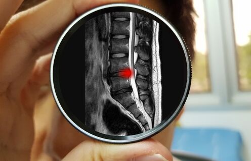 Die Folge des Ignorierens von Schmerzen im unteren Rückenbereich kann ein Bandscheibenvorfall sein. 