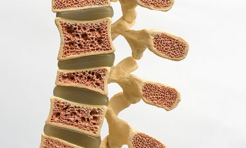Osteoporose ist eine der Ursachen für Schmerzen im unteren Rückenbereich