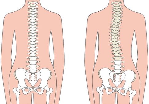 Schmerzen im unteren Rücken aufgrund einer Wirbelsäulendeformität wie Skoliose