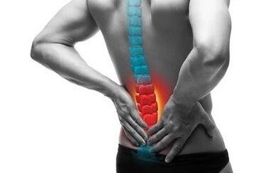 Osteochondrose ist eine Erkrankung der Wirbelsäule