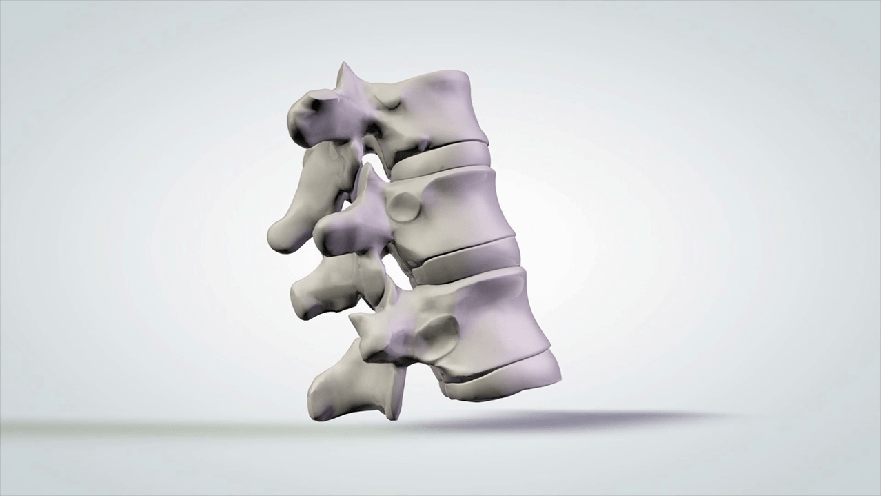 Schädigung der Wirbelsäule durch zervikale Osteochondrose