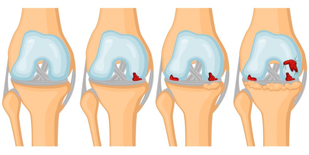 Grad der Entwicklung einer Gelenkarthrose
